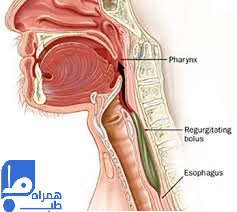 اختلال بلع 